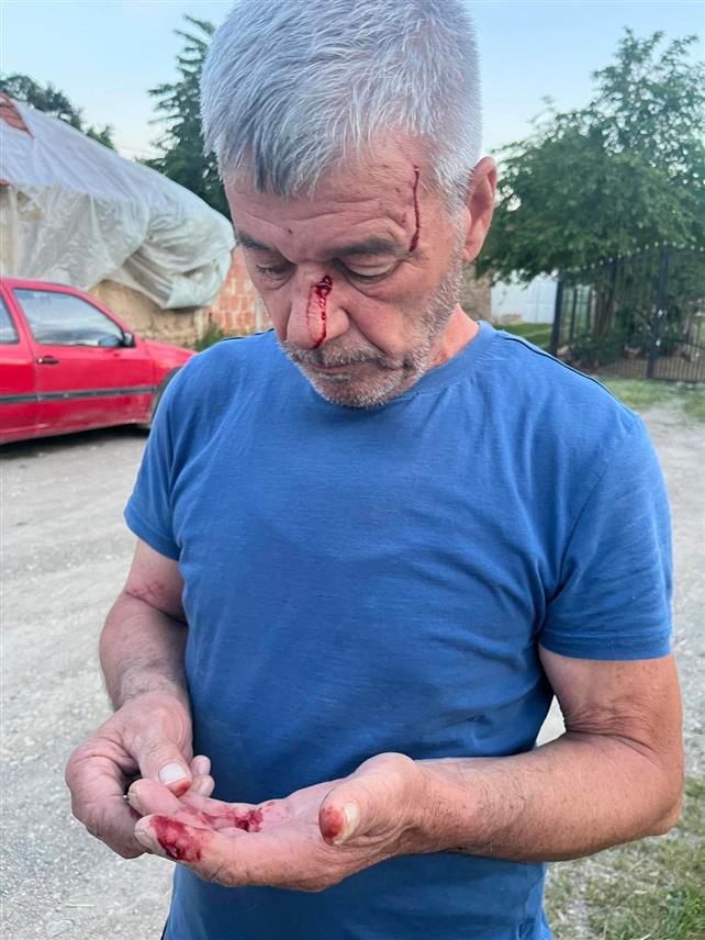 БЕОГРАД, 3. ЈУНА /СРНА/ - Албанац је брутално претукао Србина Свету Илића из села Бинач у Косовском Поморављу, који је покушао да тог комшије одбрани свог сина, саопштено је из Канцеларије Владе Србије за Косово и Метохију.