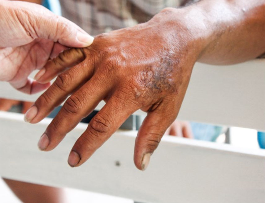 ЗАГРЕБ, 13. ДЕЦЕМБРА /СРНА/ - Губа /лепра/ потврђена је у Хрватској код страног радника из Непала