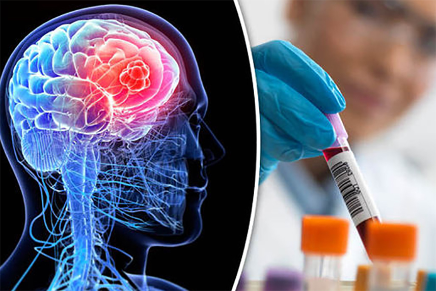 БЕРЛИН, 18. МАРТА /СРНА/ - Научници су остварили значајан корак ка развоју теста крви који открива туморе мозга са тачношћу од 90 одсто и прати их у реалном времену, саопштили су британски научници са Универзитета у Манчестеру.